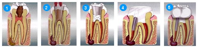 根管治疗的步骤有哪些